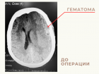 Астраханские врачи успешно удалили из головы 86-летней пациентки огромную гематому