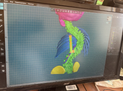 Пятилетней астраханке исправили врожденный сколиоз уникальной реберно-позвоночной конструкцией