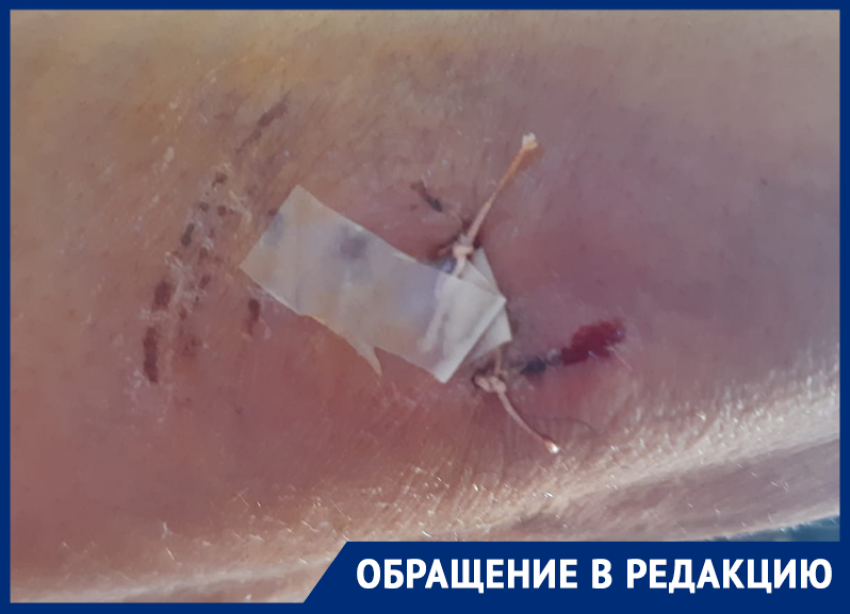 «Швы наложили в трех местах»: в Астраханской области собаки продолжают нападать на людей 