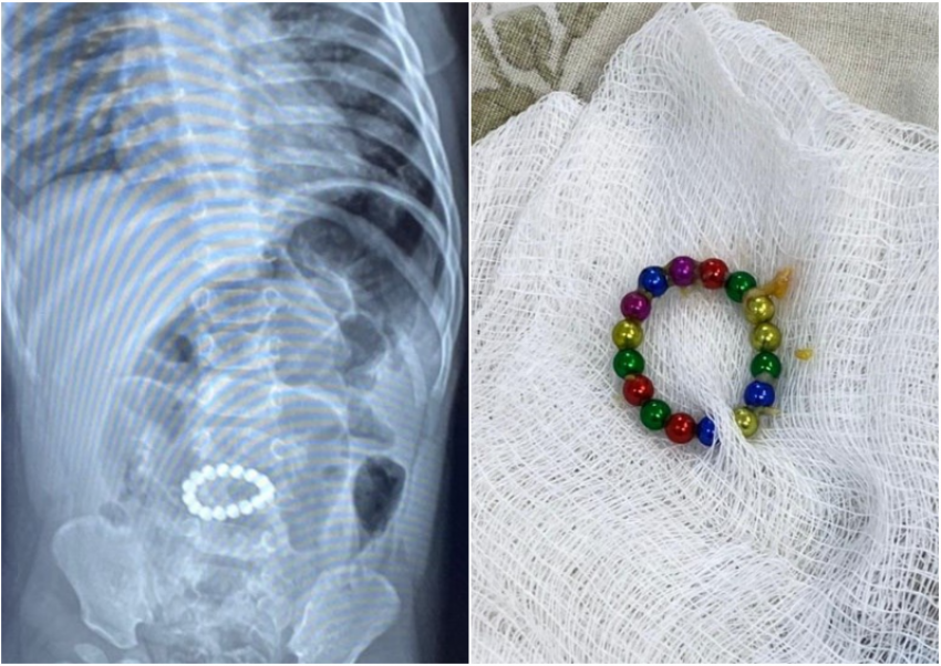 Астраханские врачи достали из кишечника двухлетнего ребенка 16 магнитов