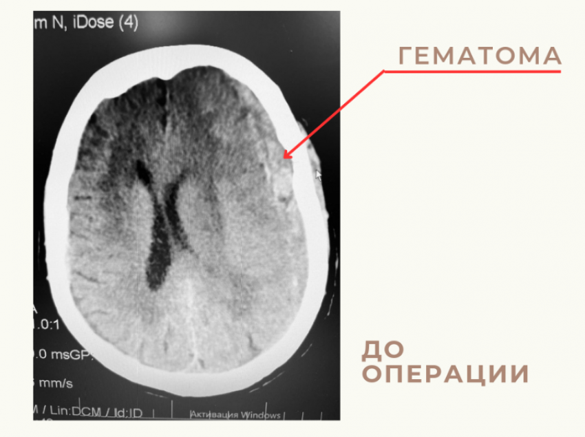Астраханские врачи успешно удалили из головы 86-летней пациентки огромную гематому