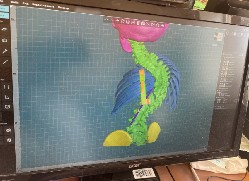 Пятилетней астраханке исправили врожденный сколиоз уникальной реберно-позвоночной конструкцией