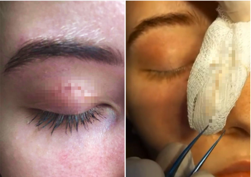 Над глазом 17-летней астраханки поселился червь-паразит